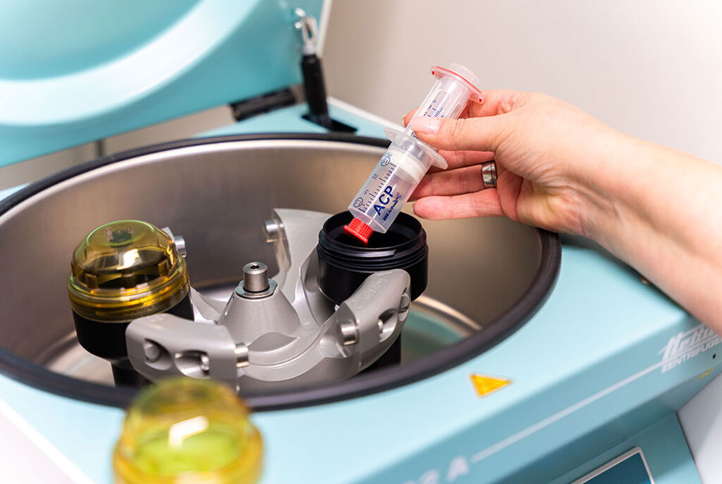Darstellung des Verfahrens für autologes Conditioniertes Plasma